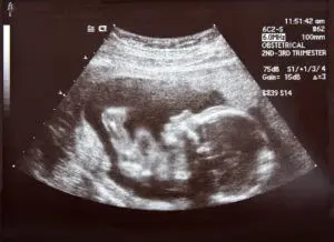 Das Baby im Ultraschall - Fragen zum Ultraschall