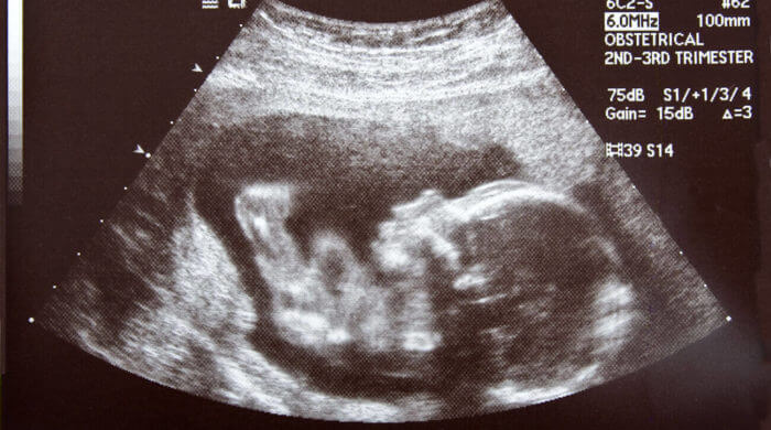 Das Baby im Ultraschall - Fragen zum Ultraschall