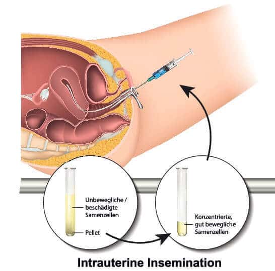 Methode der künstlichen Befruchtung: Die Samenübertragung/ Intrauterine Insemination (IUI)